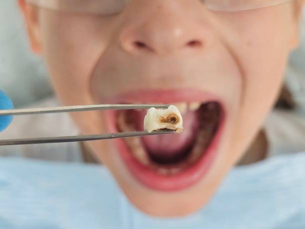 Best Emergency Tooth Extraction  in Cedar Lake, IN